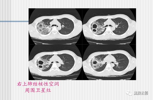 肺结核的影像学诊断