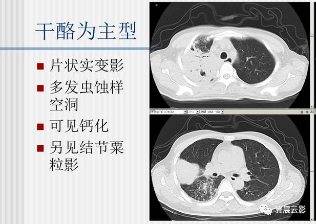 肺结核ct影像表现图解图片