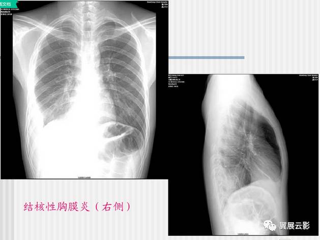 肺结核的影像学诊断