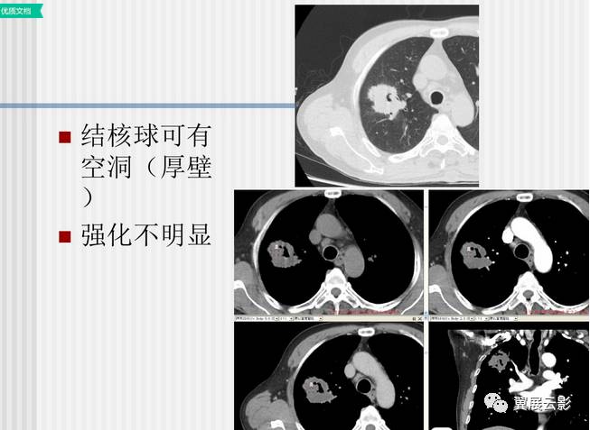 肺结核ct影像表现图解图片