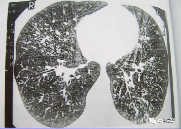 一期尘肺图片 轻微图片