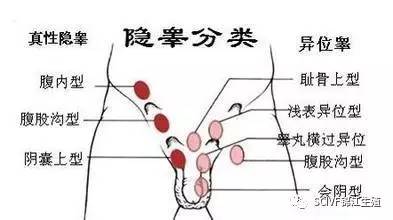 如果小儿至6个月时睾丸还未降至阴囊内