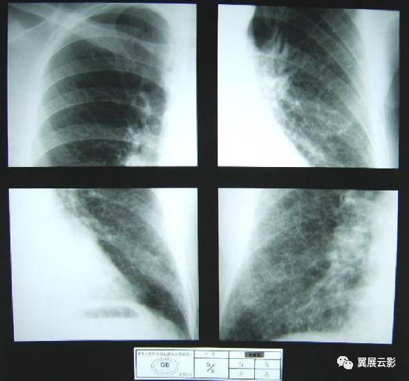 尘肺一期的ct图片 早期图片