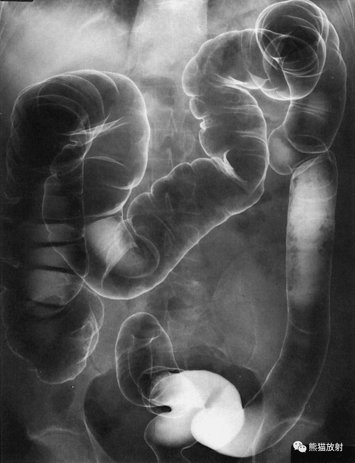 2 hepatic flexure of the colon 結腸肝曲,3 ascending colon 升結腸