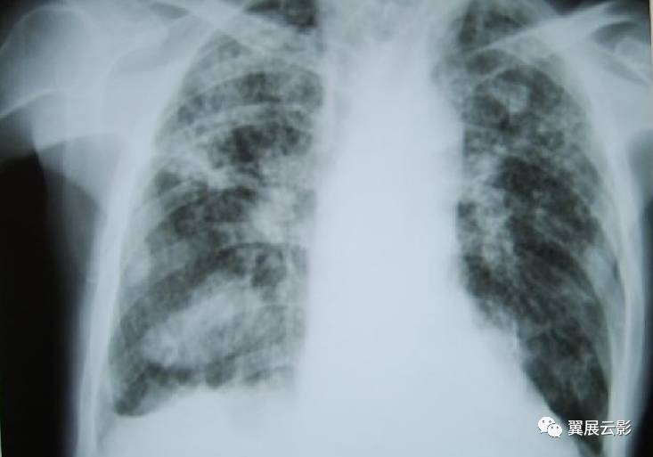 早期尘肺胸片图图片