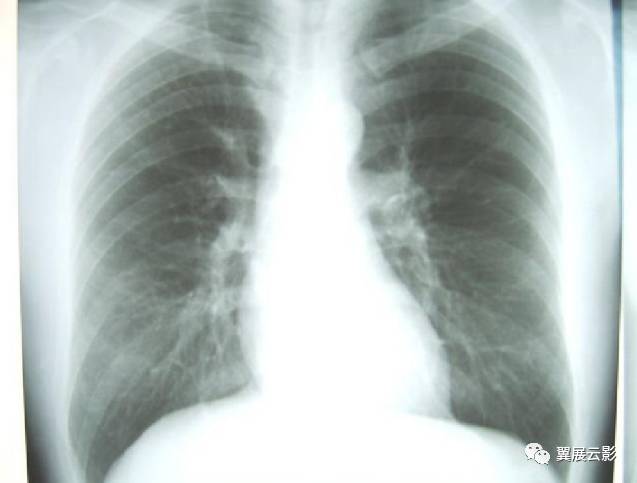 尘肺一期的ct图片 早期图片