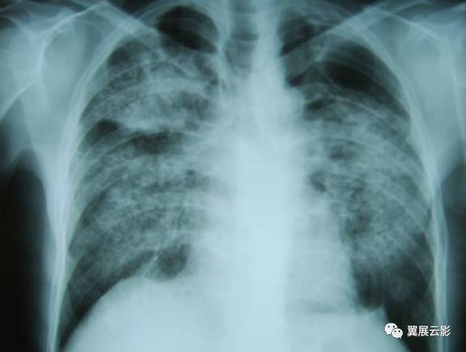 尘肺ct影像学表现图片图片