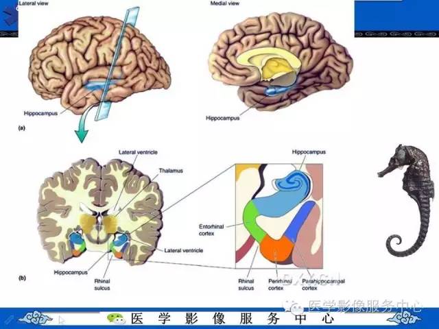 精彩幻灯海马的解剖及萎缩分级