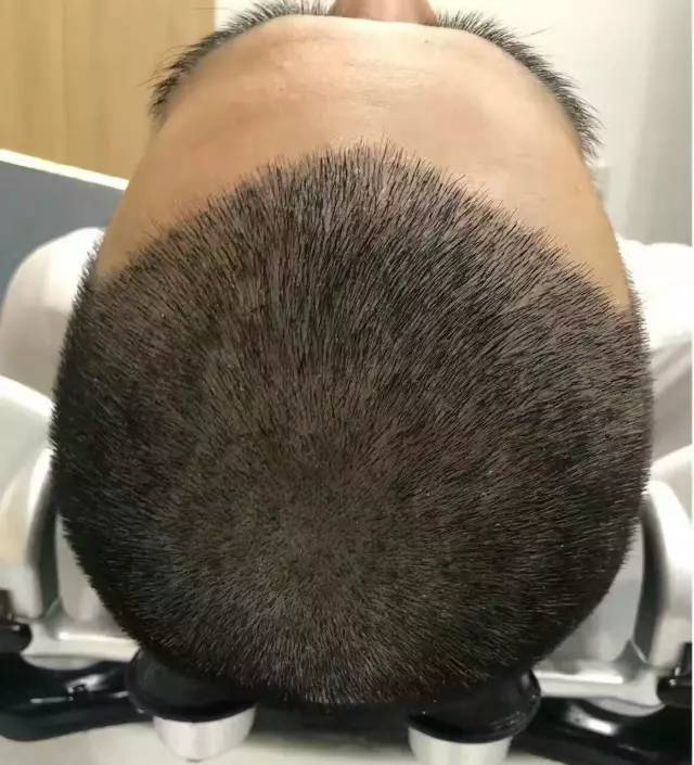 秃顶10年大叔逆袭小鲜肉脱发秃顶m型脱发这样做可以统统解决