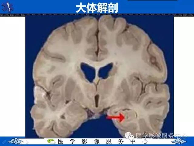 海马区断层解剖图片