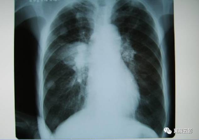 尘肺标准片26张图片图片