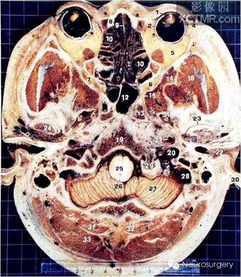 颅脑断层解剖图