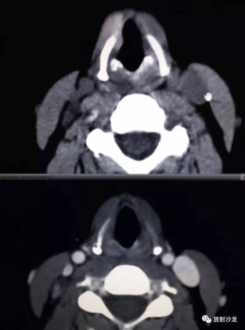 甲状腺癌ct表现图片