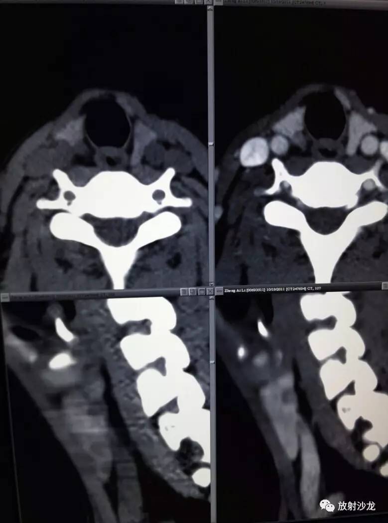 甲状腺ct平扫图片