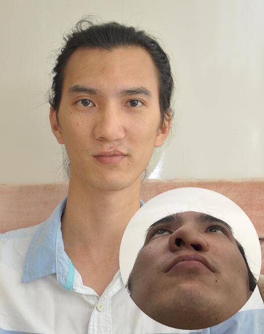 广州男子谭学敏长相清秀却患有先天唇裂鼻畸形,图为手术前