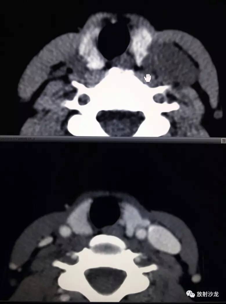 甲状腺ct平扫定位图图片