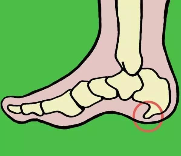 脚后跟隐隐作痛,是鞋不合适还是骨头问题?