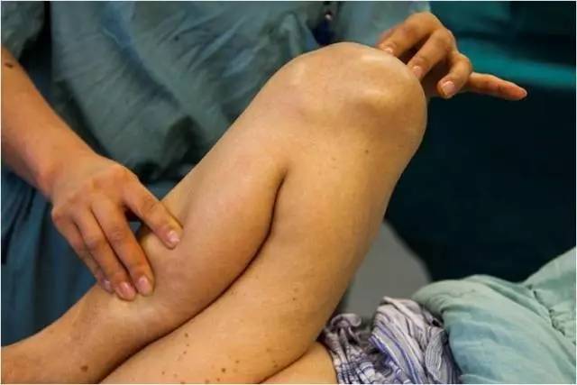这位六十多岁的谭女士,双腿严重扭曲,正常膝关节的活动范围是0至130度