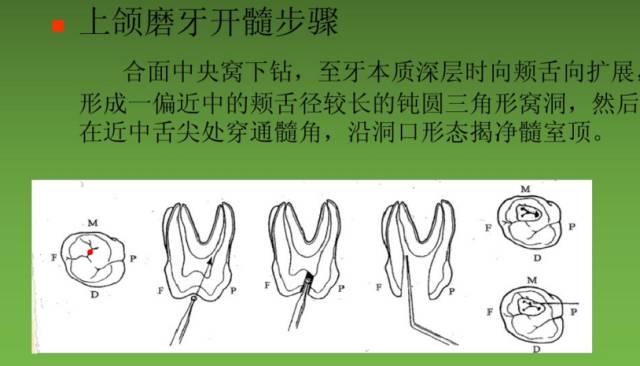 下6开髓图解图片