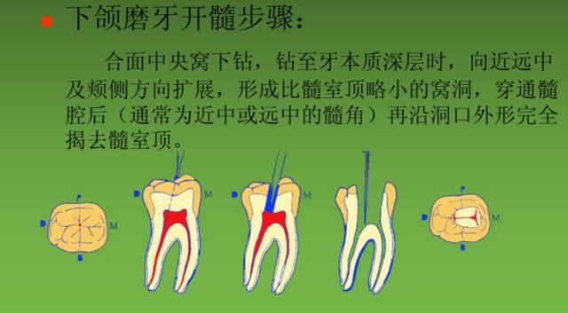 開髓術