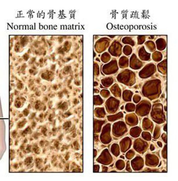 骨骼有自己的代谢系统:每天有部分骨组织被溶解破坏,又会生成新的骨