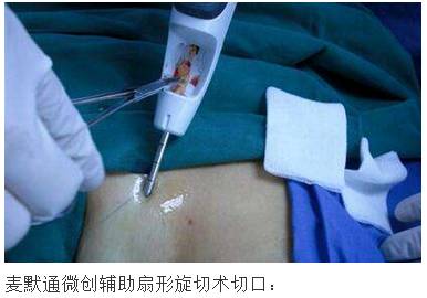 男性乳腺发育症手术图片