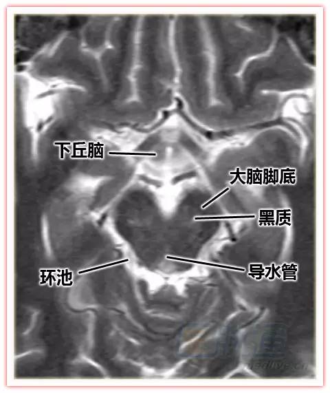 丘脑断层图片