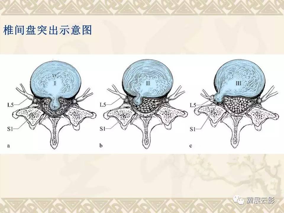 腰椎间盘突出ct的诊断