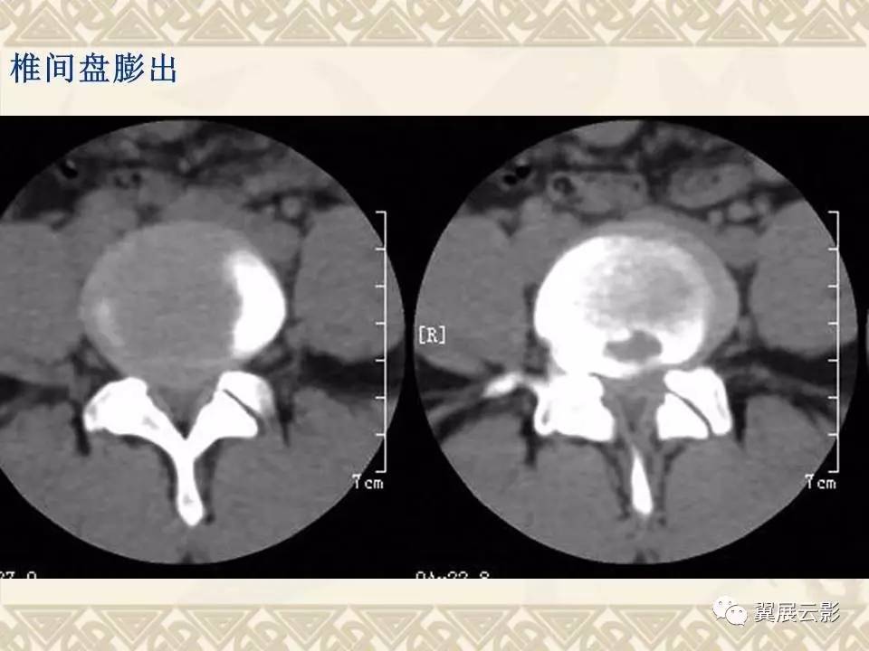 腰椎間盤突出ct的診斷