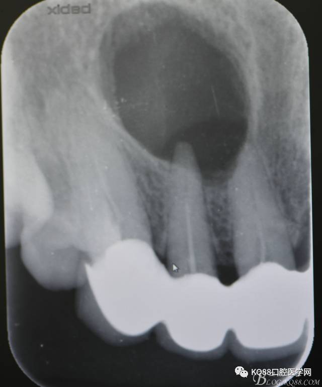 上颌侧切牙根尖手术张东星