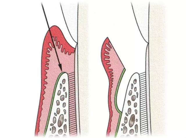 牙医学堂临床牙周病例剖析三种牙龈翻办术的选择及应用