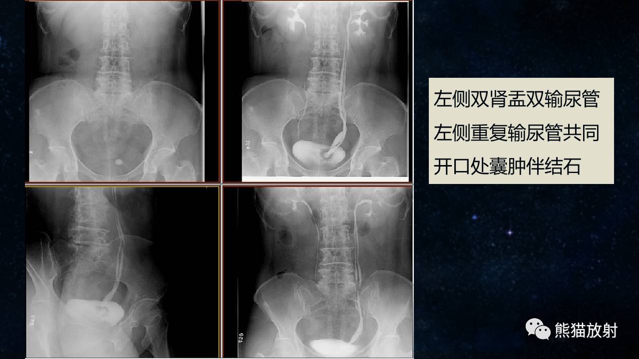 输尿管囊肿ct图片图片