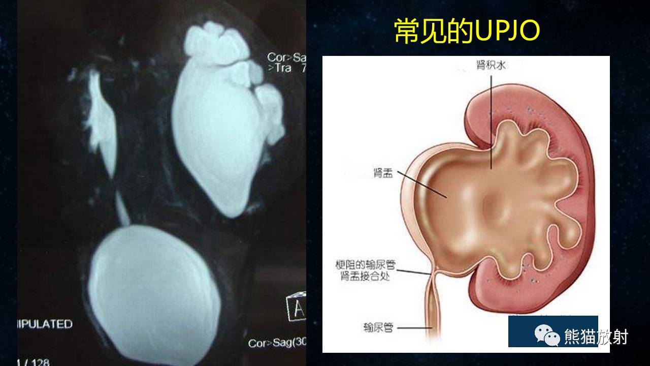 【专题】磁共振泌尿系水成像(mru)技术及临床应用该作者往期推送链接