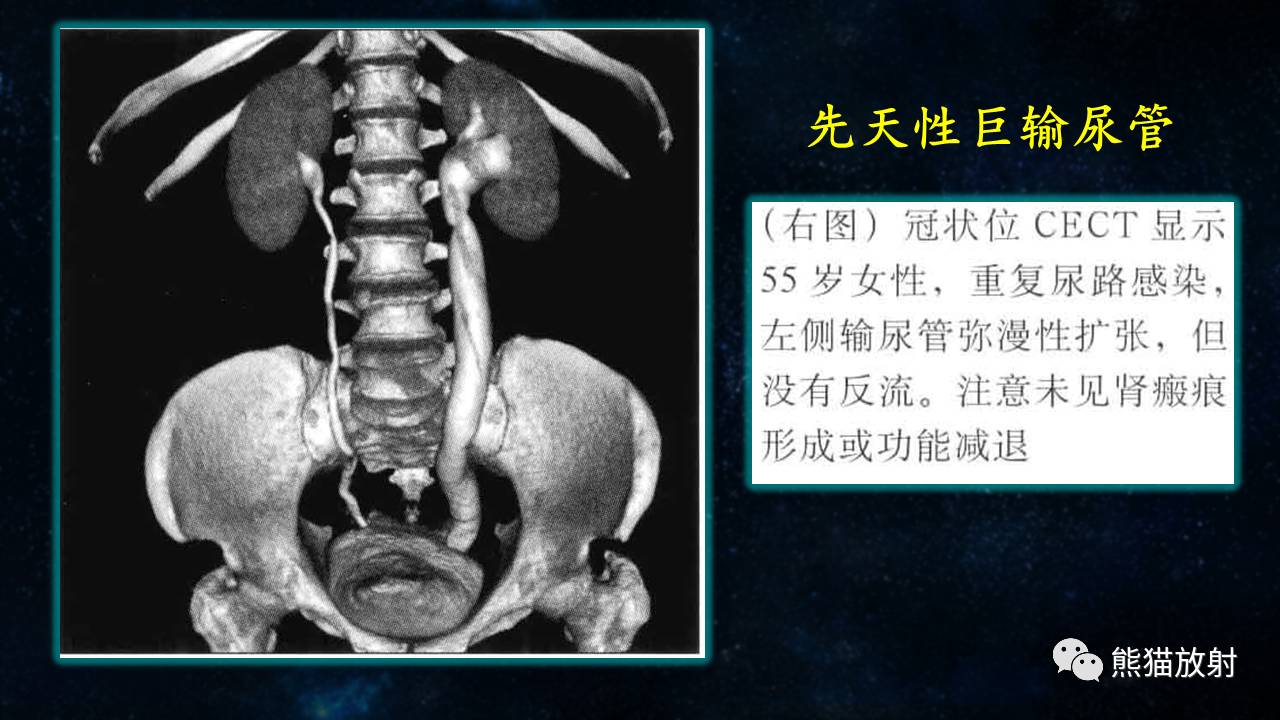 ct输尿管图像怎么看图片