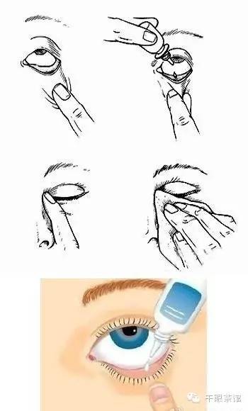 若需同时点眼药水和眼药膏,应先点眼药水后隔五分钟再抹眼药膏