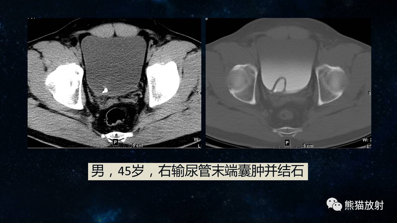 【专题】磁共振泌尿系水成像(mru)技术及临床应用该作者往期推送链接