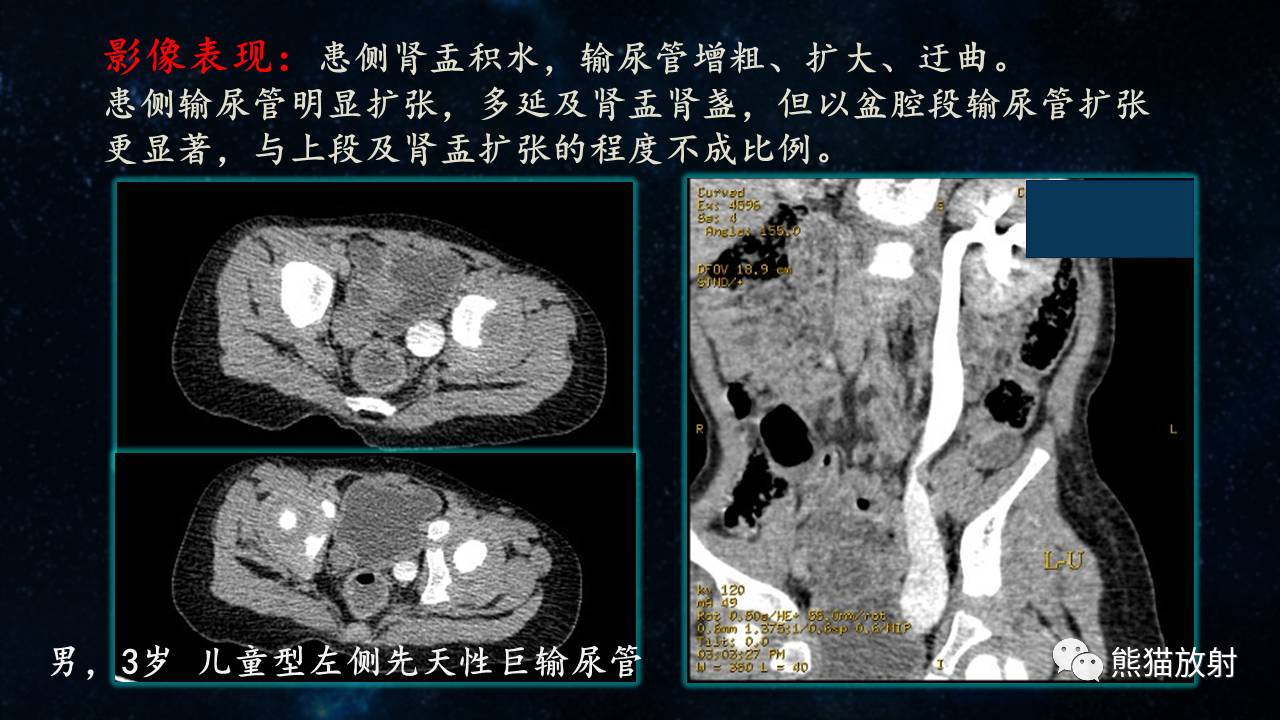 输尿管囊肿ct图片图片