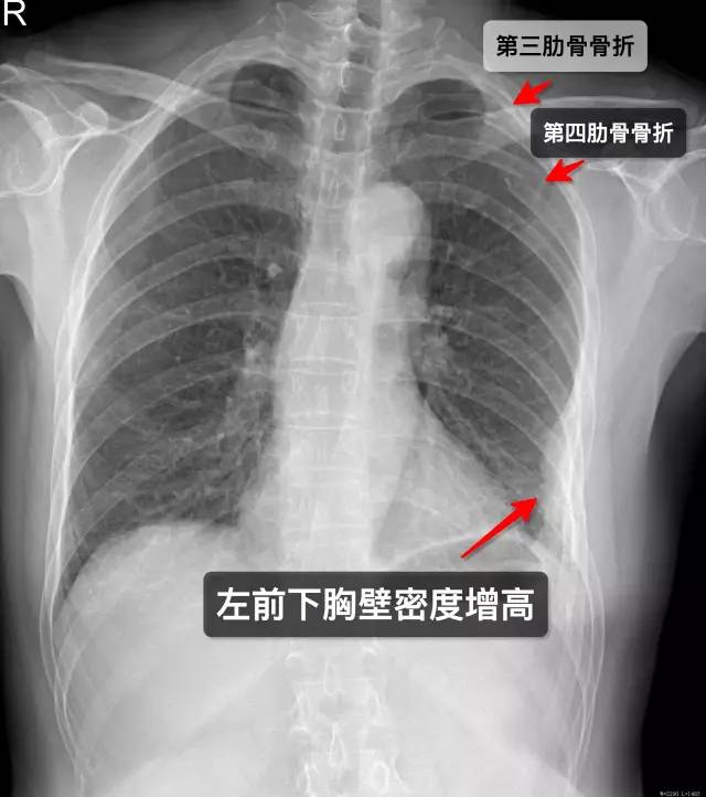 那些年你漏診過的肋骨骨折