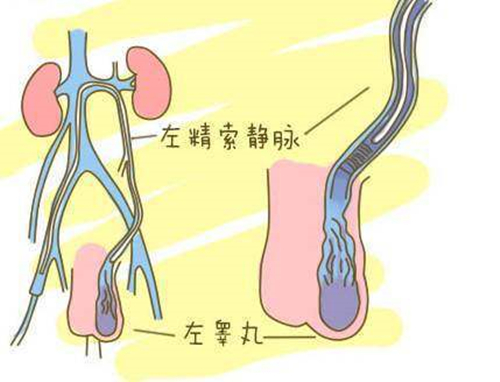 精索靜脈曲張,男人該承擔的不孕責任!