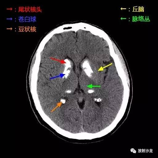 丘脑 CT图片