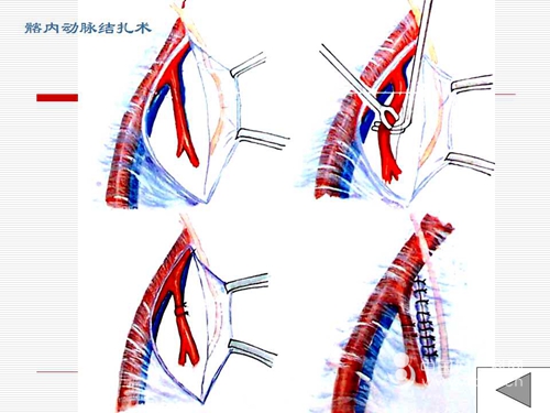 胸导管结扎术示意图图片