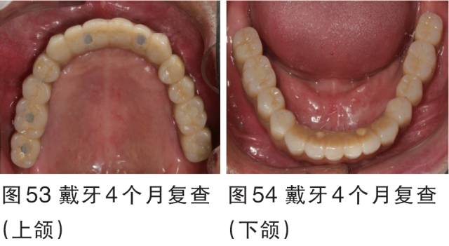 全口无牙颌种植固定修复一例