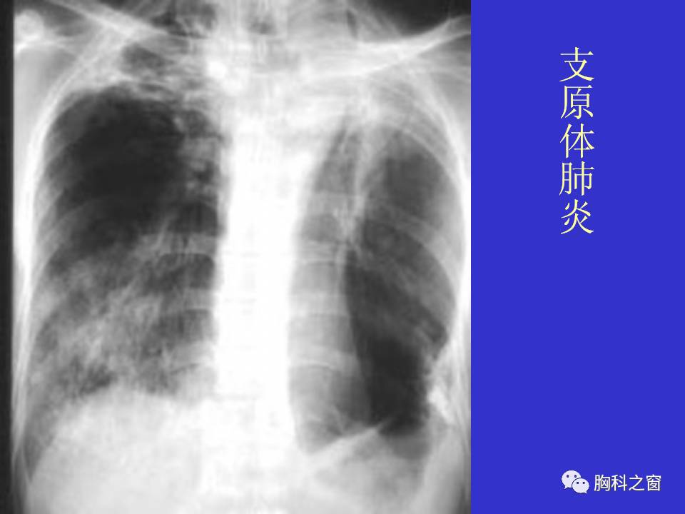 收藏最全面的肺部感染性疾病ct診斷