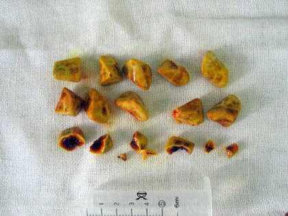 結石常是多個,直徑可以從小沙粒到1cm,混合性結石多發生在膽囊,形成