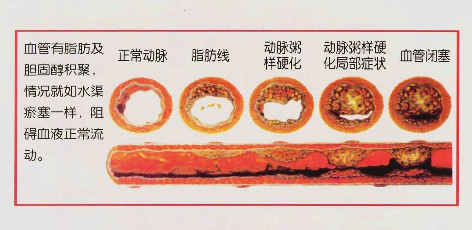 二甲双胍对2型糖尿病合并动脉粥样硬化患者血清基质金属蛋白酶2,il-6