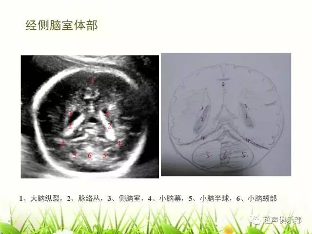 胎儿超声颅内结构图图片