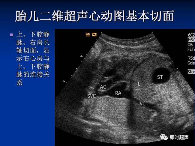 胎儿心脏扫查方法及胎儿正常超声心动图