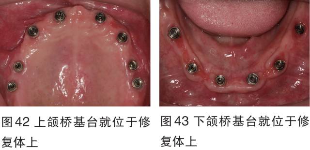 全口無牙頜種植固定修復一例