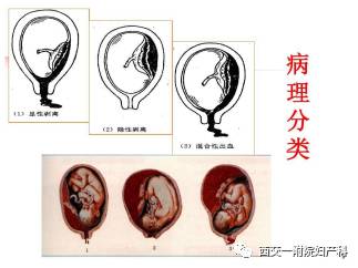 胎盘早剥图片 显性图片