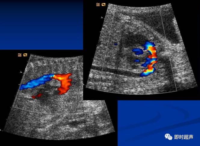 胎儿心脏扫查方法及胎儿正常超声心动图
